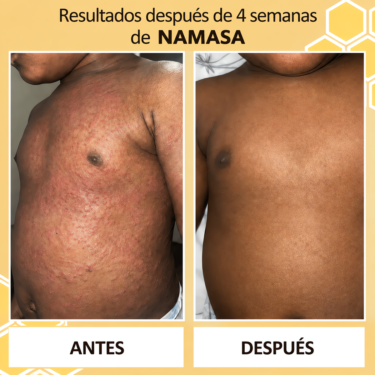 NAMASA™ Crema de Miel para Eczema